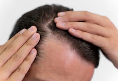 Cinco señales para detectar a tiempo la caída del cabello y prevenir la calvicie