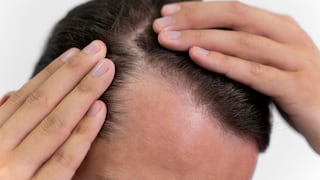 Cinco señales para detectar a tiempo la caída del cabello y prevenir la calvicie