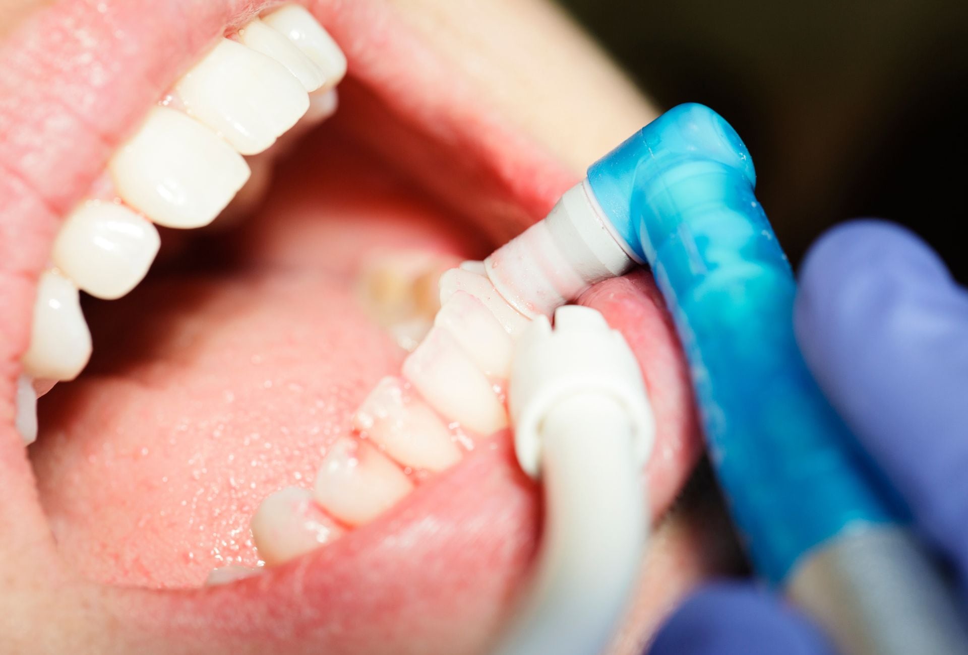 Especialistas destacan que el flúor sigue siendo clave para prevenir caries, siempre que se utilice en dosis correctas y bajo orientación profesional.