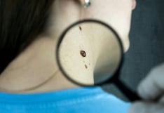 Día Mundial del Cáncer de Piel: melanoma se detecta en etapas avanzadas