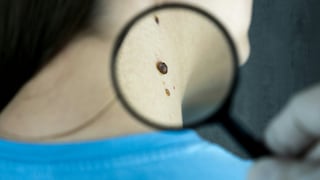 Día Mundial del Cáncer de Piel: melanoma se detecta en etapas avanzadas