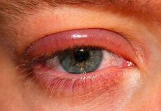 Blefaritis: ¿qué causa esta enfermedad ocular y cómo se trata?