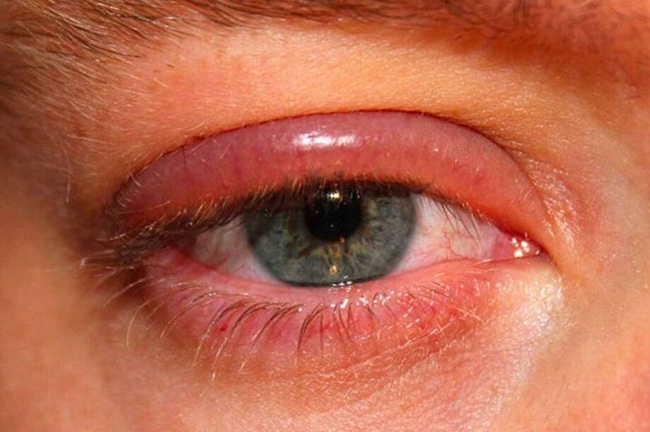 Una enfermedad visual que afecta a personas de todas las edades. Según especialista, la higiene regular de los párpados, reducir el uso de pantallas y las revisiones oftalmológicas son esenciales para prevenir la blefaritis.