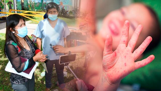 Huánuco: Red de Salud Leoncio Prado reporta 61 casos de Coxsackie