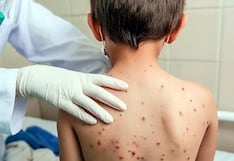 Huancayo: Confirman primer caso de sarampión en niño de 7 años y hay 36 sospechosos