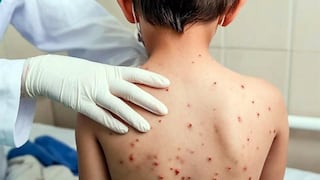 Huancayo: Confirman primer caso de sarampión en niño de 7 años y hay 36 sospechosos