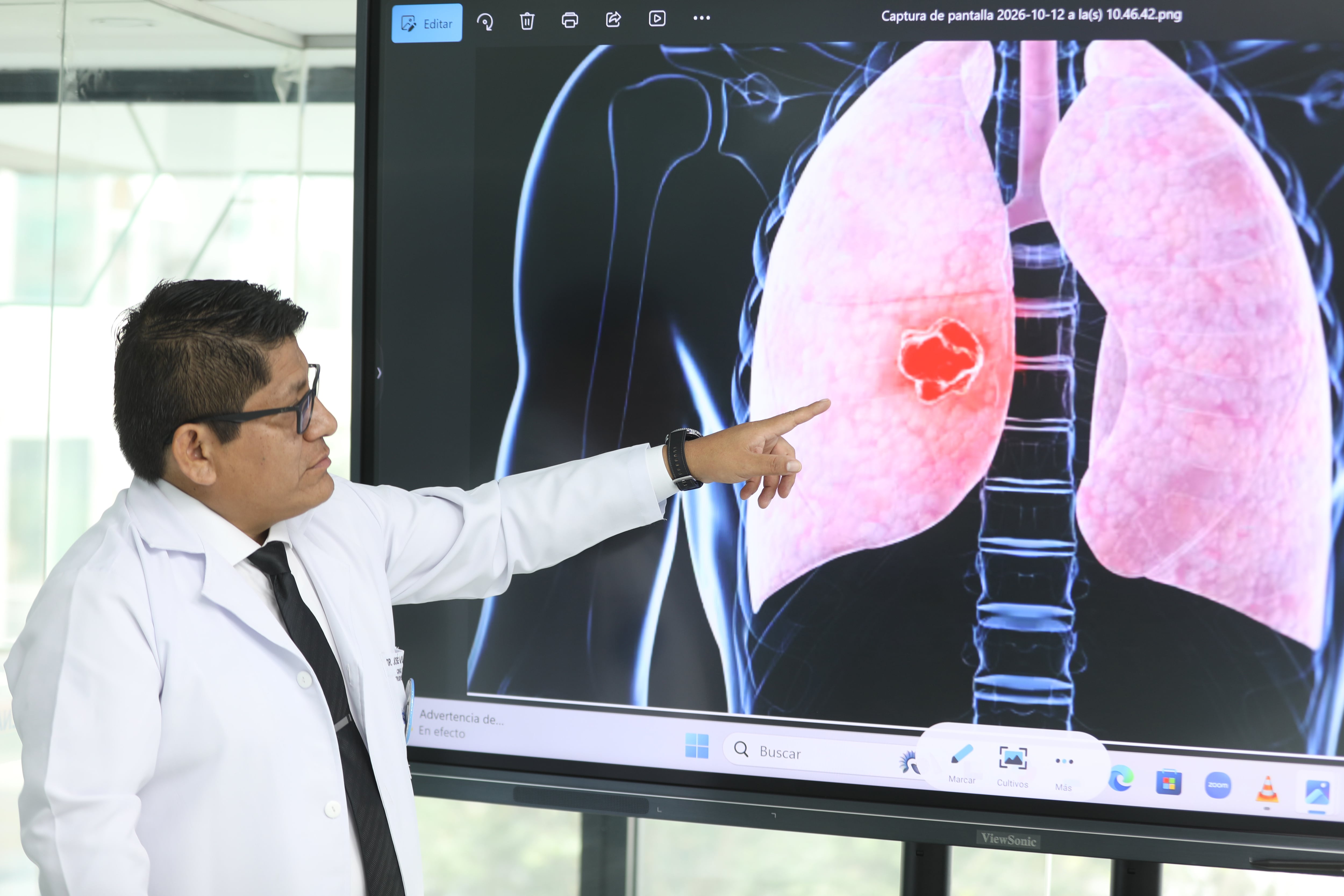 A propósito de las informaciones sobre la operación del papa León XIV, un especialista del Hospital Almenara explica cómo se evalúan los nódulos pulmonares, qué determina la necesidad de una cirugía y cuánto tiempo puede permanecer hospitalizado un paciente. (Fotos: EsSalud)