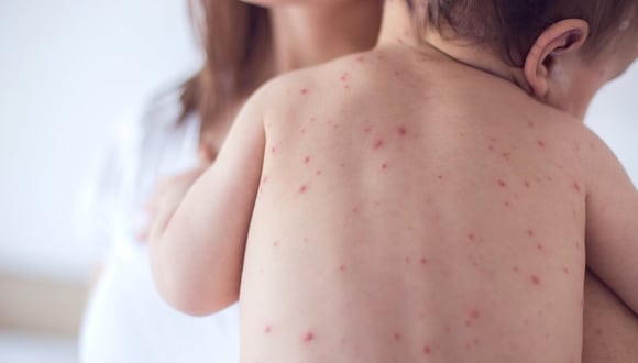 Ministerio de Salud exhorta a vacunar a niños menores de 5 años contra el sarampión.