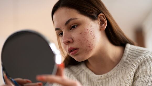 Limpiar adecuadamente la piel, mantener un estilo de vida saludable y evitar el uso productos inadecuados ayudarán a reducir el acné.