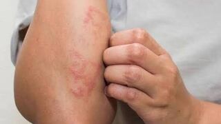 Piura: Paciente con lepra está estable y con tratamiento médico