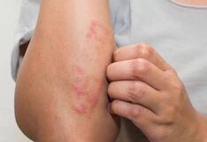 Piura: Paciente con lepra está estable y con tratamiento médico