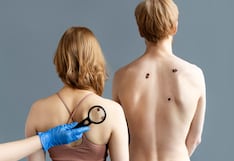 Lunares y lesiones en la piel: ¿cuándo pueden ser una señal de cáncer?