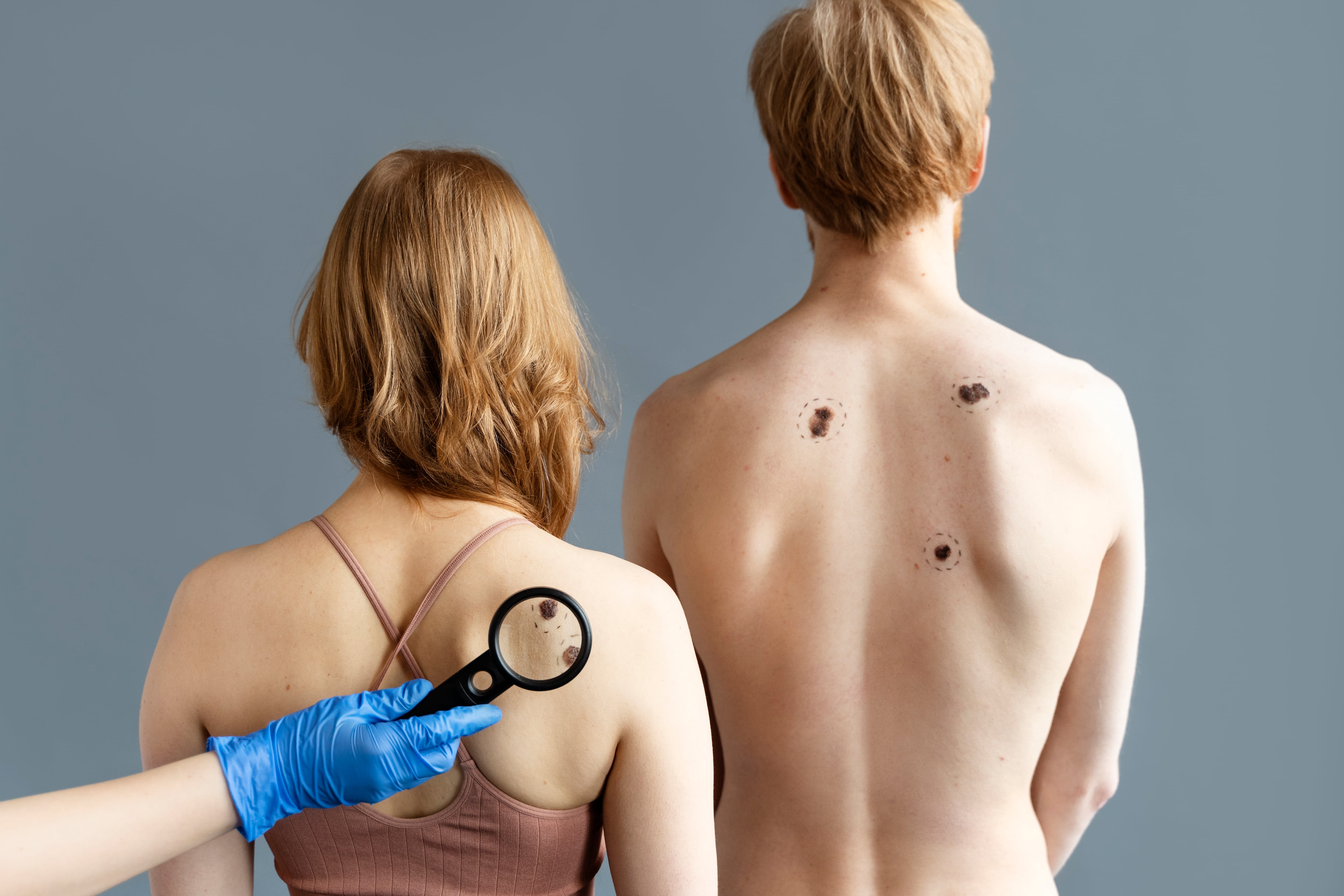 Dermatóloga explica las señales de alerta y la importancia de la detección temprana frente a la alta radiación solar.