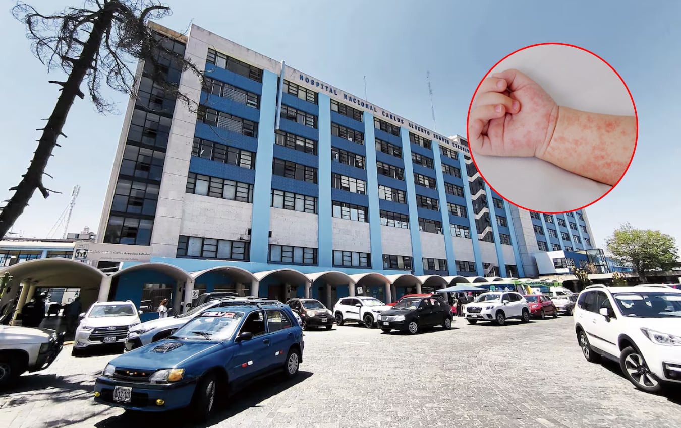 Confirman tercer caso importado de sarampión en Arequipa. Foto: Composición GEC.