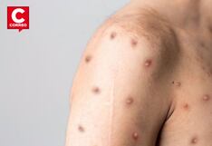 Minsa informa que aún no se registran casos con nueva variante de viruela del mono en Perú