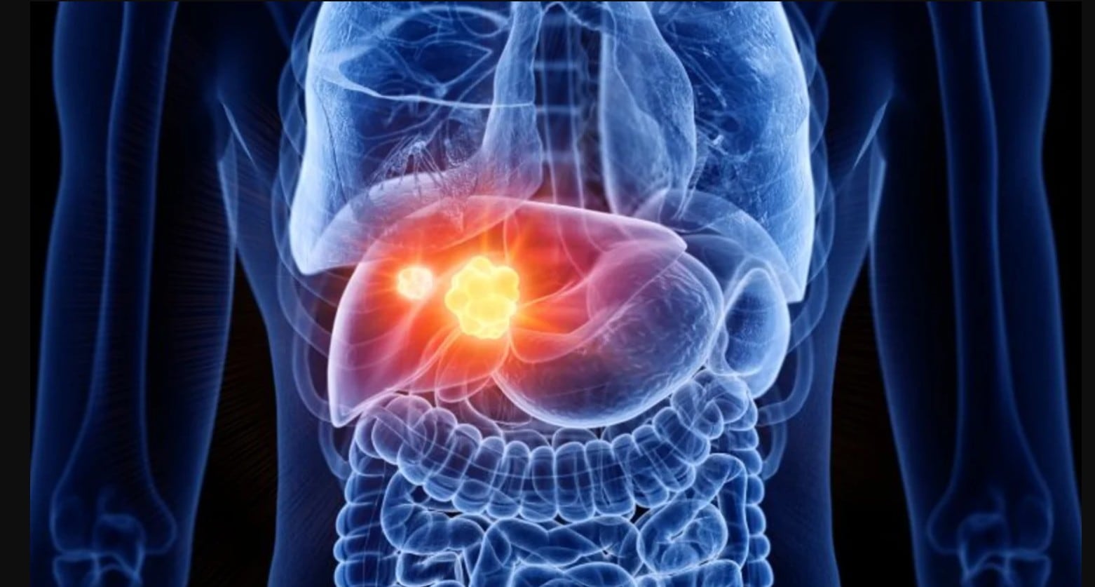 La infección crónica por hepatitis B puede provocar daño hepático y elevar el riesgo de carcinoma hepatocelular. La vacunación, las pruebas de detección y el seguimiento médico son claves para reducir complicaciones.