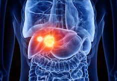 Hepatitis B: cómo este virus silencioso puede aumentar el riesgo de cáncer de hígado
