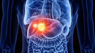 Hepatitis B: cómo este virus silencioso puede aumentar el riesgo de cáncer de hígado