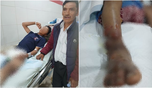 Víbora ataca a menor y veneno se prolongó rápidamente dejándolo en el hospital