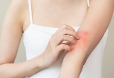 Cuidado de la piel: ¿Cuáles son las erupciones más comunes por el calor y cómo evitarlas?