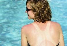 Verano: ¿Cómo prevenir y tratar las quemaduras solares de forma efectiva?