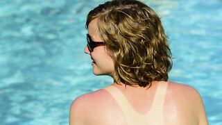 Verano: ¿Cómo prevenir y tratar las quemaduras solares de forma efectiva?