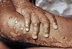 La Libertad registra cinco casos de viruela símica