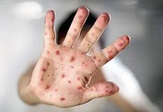 Detectan dos casos sospechosos de la viruela del mono en Piura