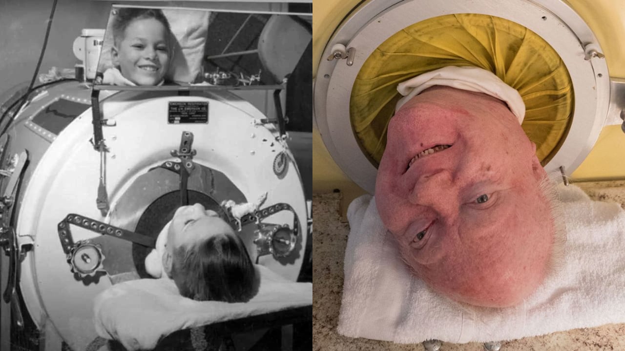 Paul Alexander murió a los 78 años de edad.