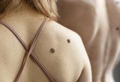 En lo que va del año, La Libertad ya presenta 29 casos de melanoma maligno