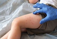 Aumenta casos de sarampión a 24 en Arequipa tras confirmarse 8 nuevos contagios
