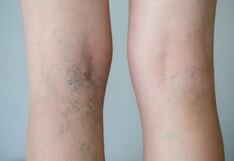 Varices: ¿Cómo combatirlas y mejorar la circulación?