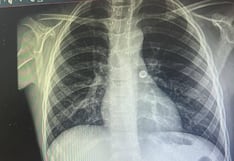 Médico extrae un chinche que tragó un niño de 8 años por accidente en Arequipa