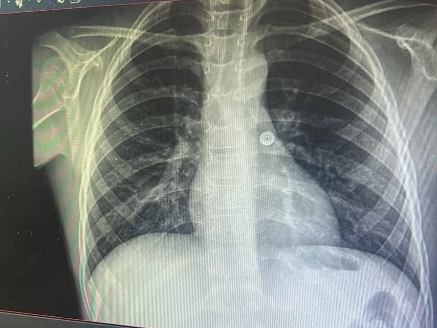 Médico extrae un chinche que tragó un niño de 8 años en Arequipa