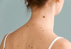 En La Libertad se detectaron 402 casos de cáncer de piel en 2024