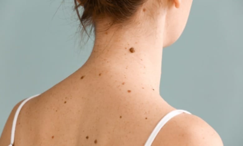 De ellos 218 fueron mujeres y 184 hombres, según el Ministerio de Salud. En respuesta a esta situación, el sistema de salud peruano cuenta con tratamientos de alta complejidad como la cirugía especializada y la inmunoterapia, disponibles en los Institutos Regionales de Enfermedades Neoplásicas (IREN)