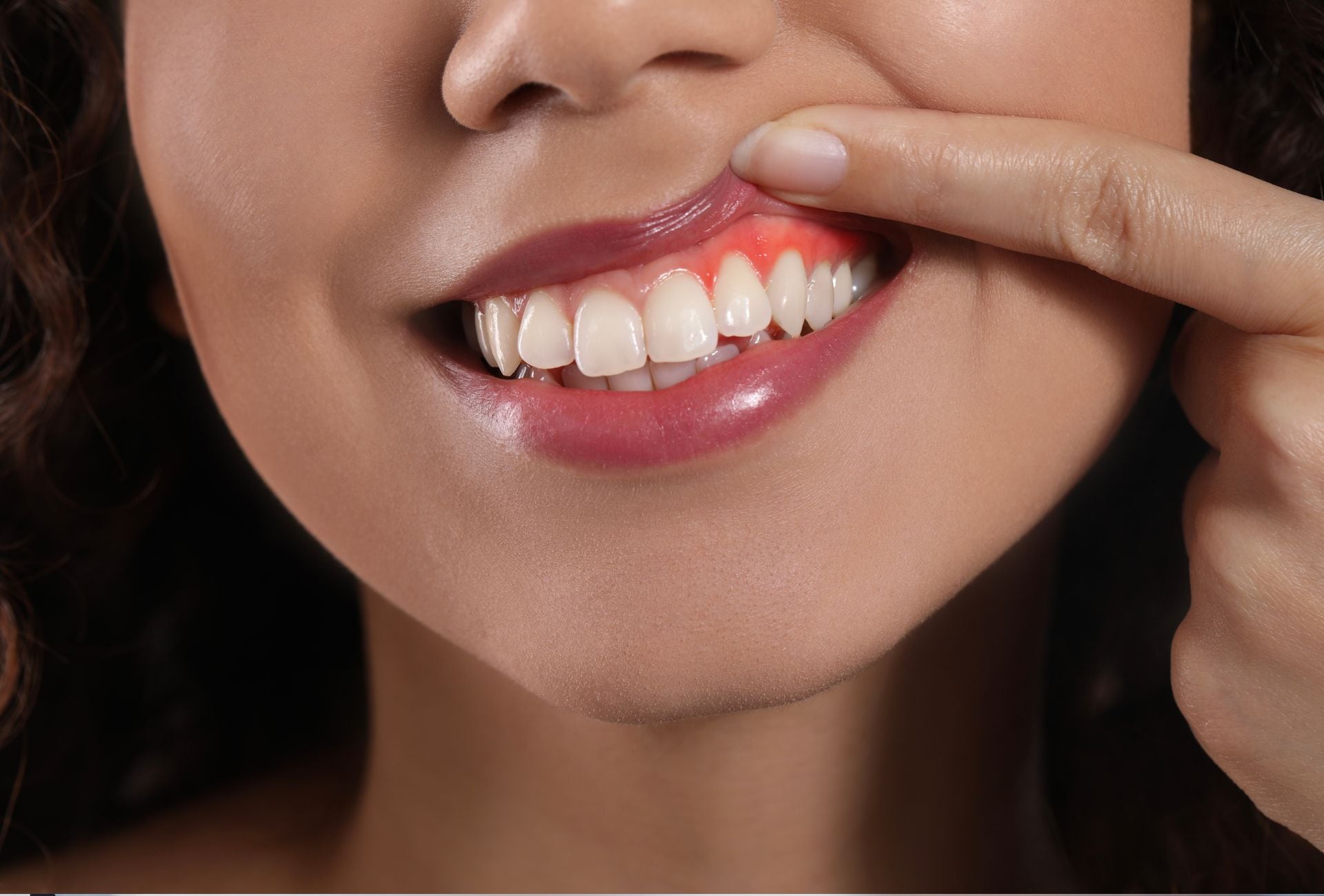 Especialistas advierten que el sangrado al cepillarse no debe normalizarse. La acumulación de placa bacteriana es la principal causa, pero también puede estar asociada a enfermedades sistémicas.