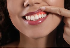 ¿Por qué sangran las encías? Síntomas de alerta que pueden indicar gingivitis o periodontitis