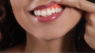 ¿Por qué sangran las encías? Síntomas de alerta que pueden indicar gingivitis o periodontitis
