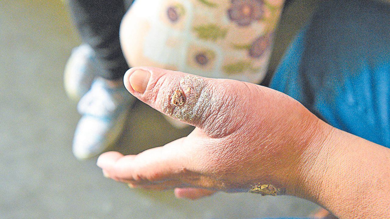 Según la Geresa, en lo que va de este 2024 y el año pasado se han reportado 63 personas afectadas con este mal. Santiago de Chuco es la provincia más golpeada.