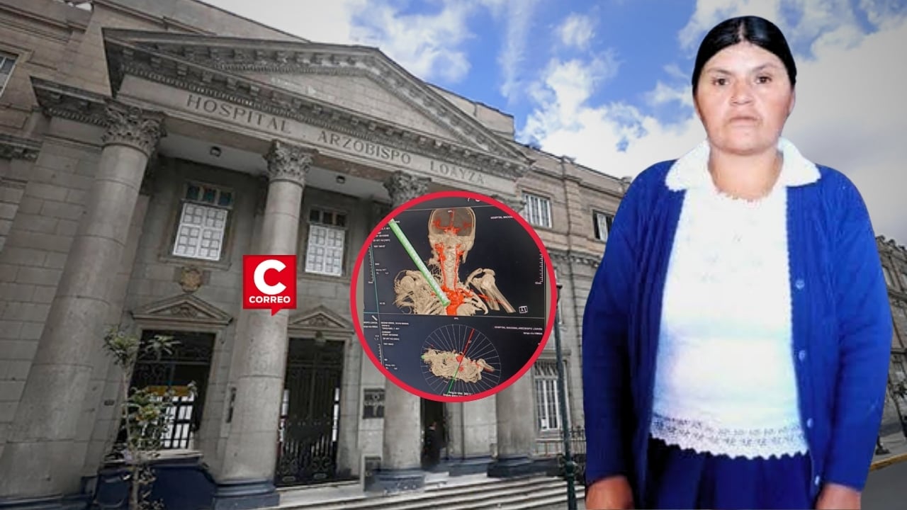 Hospital Loayza retira con éxito fierro incrustado cerca del corazón de mujer trasladada desde Áncash. Composición: Diario Correo.