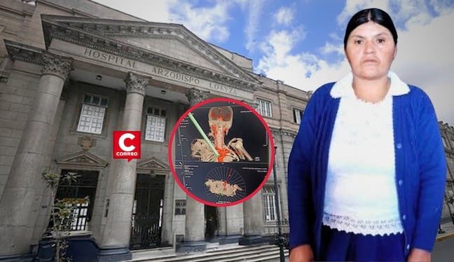 Hospital Loayza retira con éxito fierro incrustado cerca del corazón de mujer trasladada desde Áncash. Composición: Diario Correo.