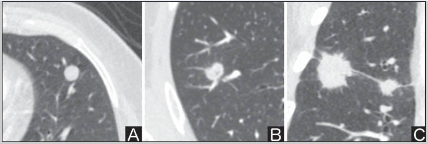 Nódulo pulmonar solitario. Las tomografías muestran lesiones con márgenes lisos, lobulados e irregulares. Aunque los bordes irregulares pueden elevar la sospecha de cáncer, la evaluación también considera el tamaño, el crecimiento y otros hallazgos para estimar el riesgo de malignidad. La imagen no permite establecer por sí sola si la enfermedad está avanzada. Fuente: Mosmann MP, Borba MA, de Macedo FP, Liguori Ade A, Villarim Neto A, de Lima KC. Solitary pulmonary nodule and (18)F-FDG PET/CT. Part 1: epidemiology, morphological evaluation and cancer probability. Radiol Bras. 2016 Jan-Feb;49(1):35-42. doi: 10.1590/0100-3984.2014.0012. PMID: 26929459; PMCID: PMC4770395.
