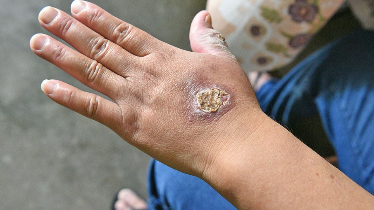 La provincia más afectada con esta enfermedad es Santiago de Chuco, que tiene 111 pacientes. Gerencia de Salud dice que llegaron ampollas para esta enfermedad.