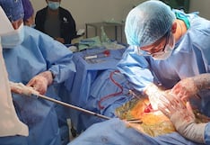Médico huanca usa clips de titanio para reconstruir tórax de minero herido