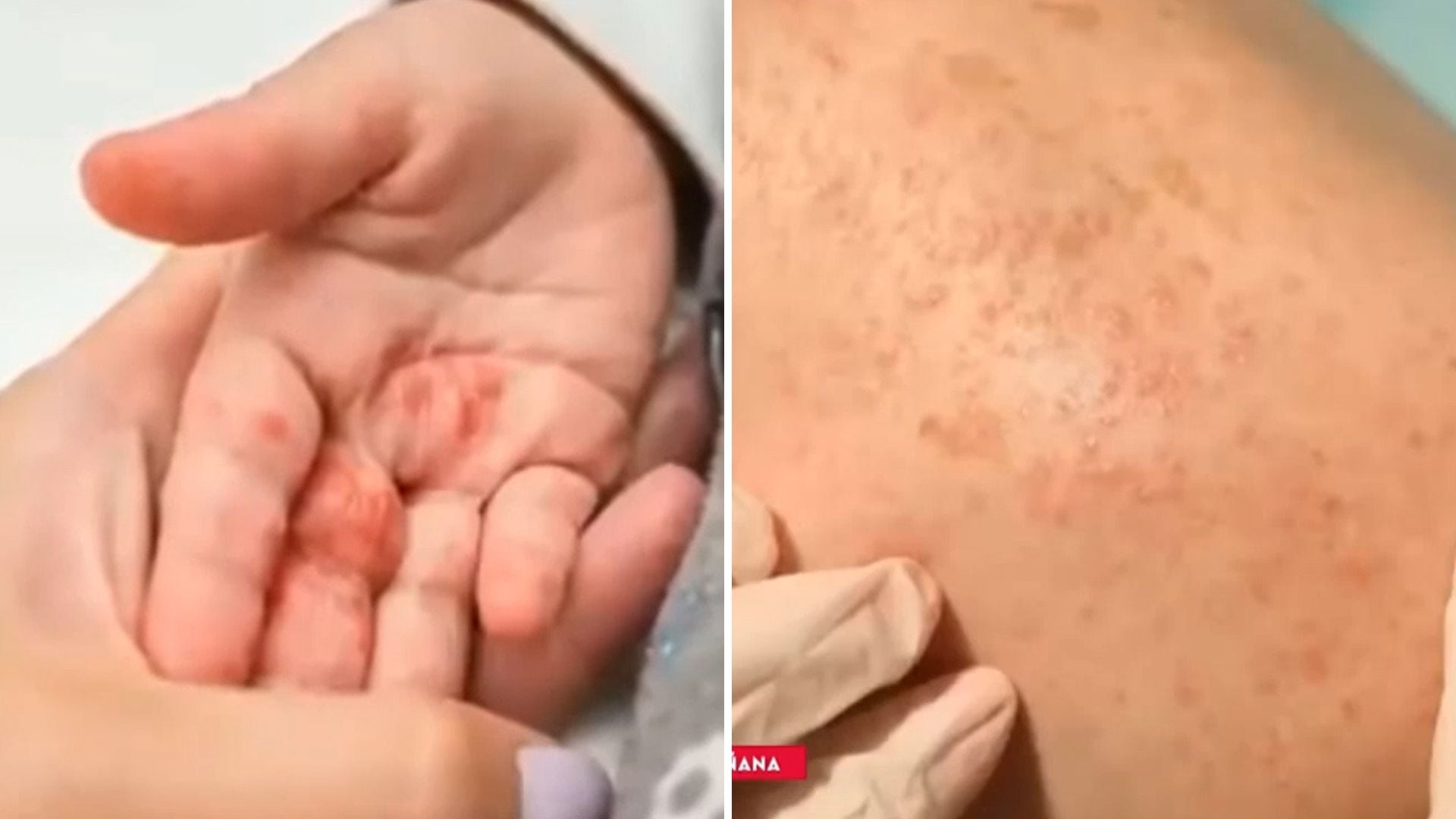 Especialista indicó que la deshidratación y la somnolencia son algunos de los síntomas más evidentes en menores afectados por esta enfermedad viral.