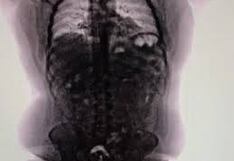 Peruano fue detenido en Argentina por llevar 90 cápsulas de cocaína en el estómago