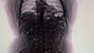 Peruano fue detenido en Argentina por llevar 90 cápsulas de cocaína en el estómago