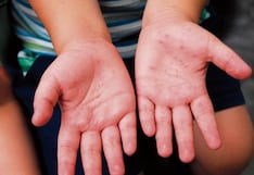 Piura reporta 10 casos del virus Coxsackie