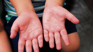 Piura reporta 10 casos del virus Coxsackie